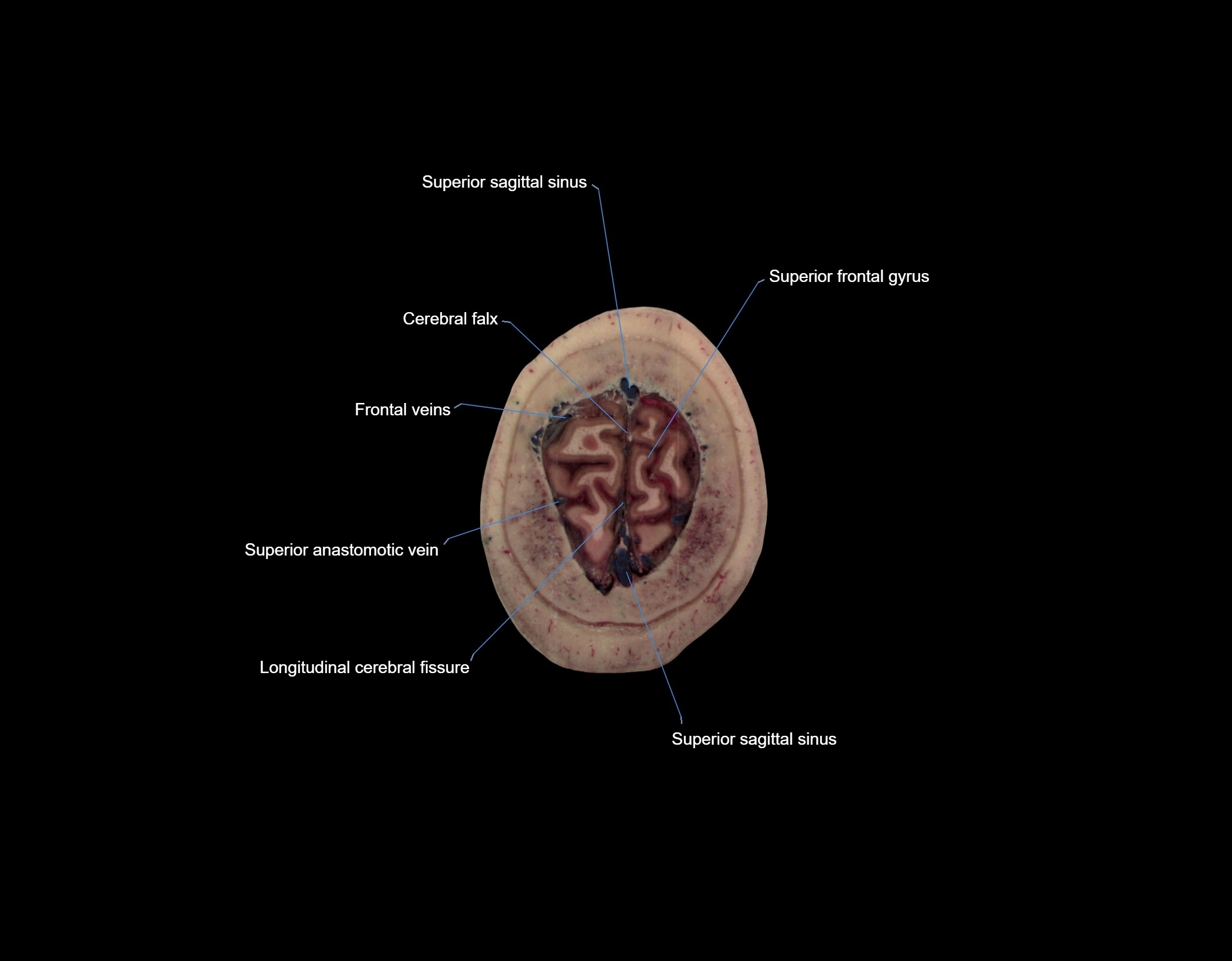 MRI Brain axial cross sectional radiology anatomy 3T image  -img-000073.webp